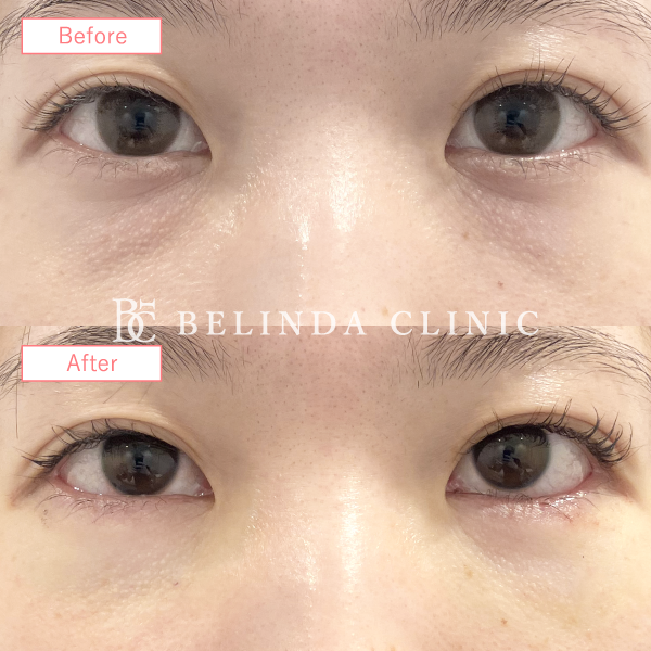 切らないクマ取りたるみ取り症例No5983