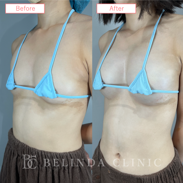 脂肪豊胸症例No607