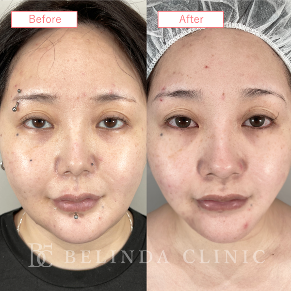 小顔脂肪吸引症例No639