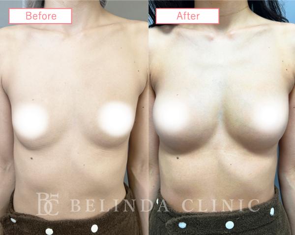 脂肪豊胸症例No6691