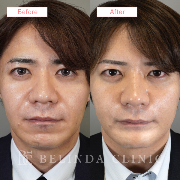 糸リフト症例No6772