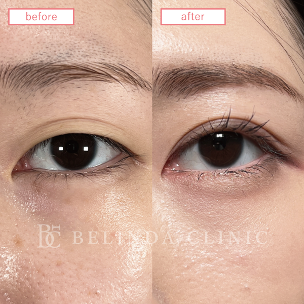 二重整形埋没法症例No691