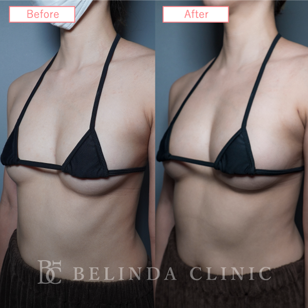 脂肪豊胸症例No7019