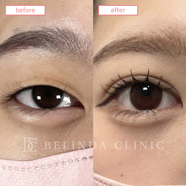 二重整形埋没法症例No704