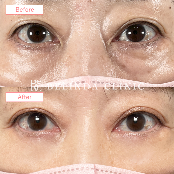 切らないクマ取り・裏ハムラ法症例No754