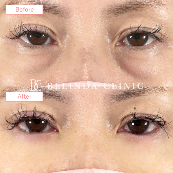 切らないクマ取りたるみ取り症例No769