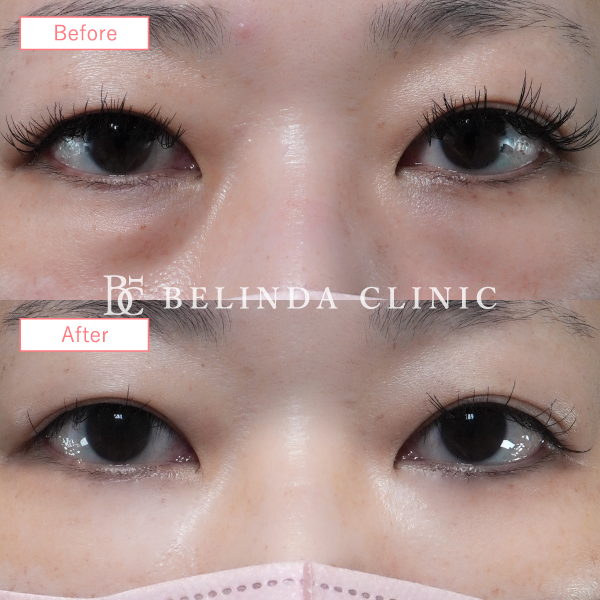 切らないクマ取りたるみ取り症例No857