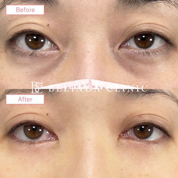 切らないクマ取りたるみ取り症例No976