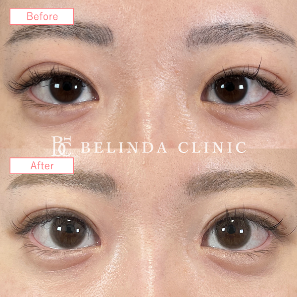 目上切開症例staff