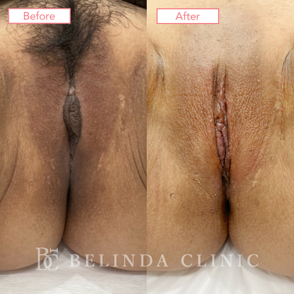 小陰唇縮小術No374