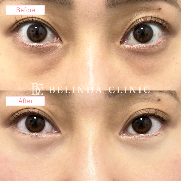 切らないクマ取りたるみ取り症例No6531