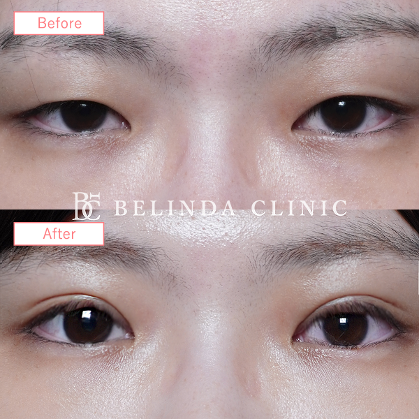 二重整形埋没法症例No6610