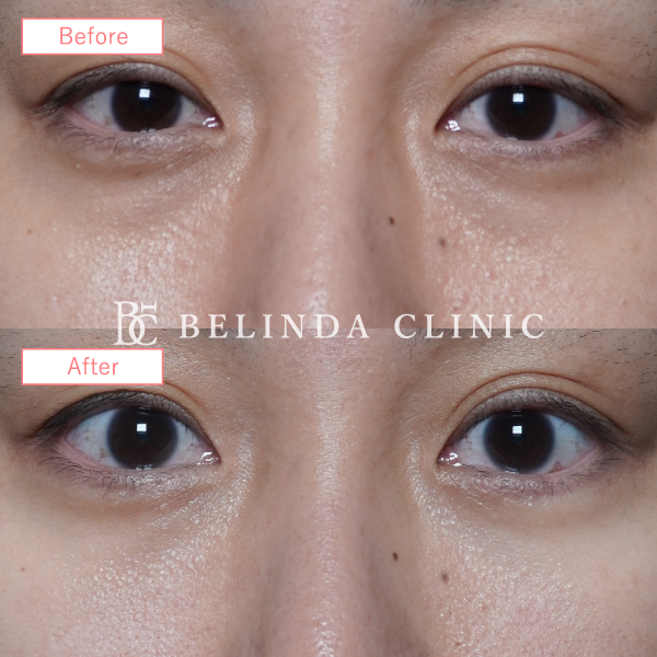 切らないクマ取りたるみ取り症例No6829