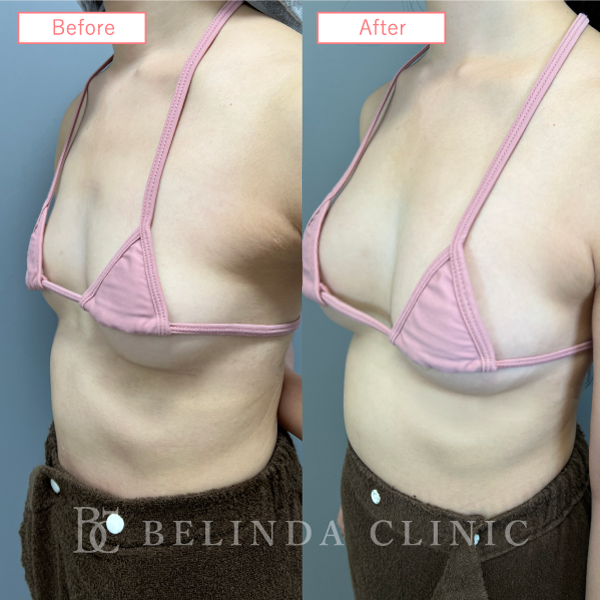 脂肪豊胸症例No6842