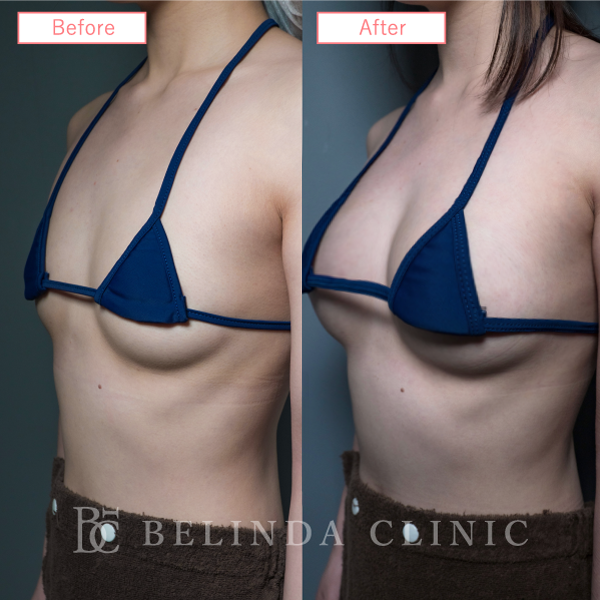 脂肪豊胸症例No7040