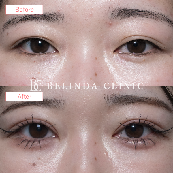 二重整形埋没法症例No7121