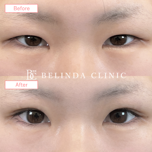 二重整形埋没法症例No7130