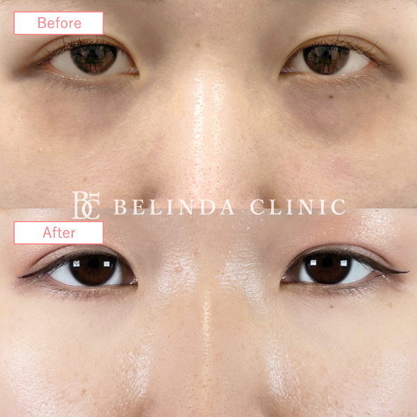 切らないクマ取りたるみ取り症例No7244