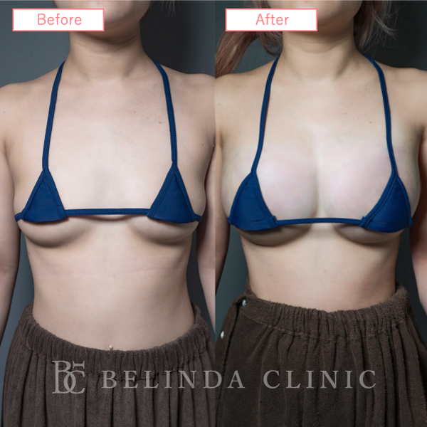 脂肪豊胸症例No7282