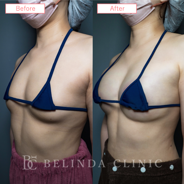 脂肪豊胸症例No7548