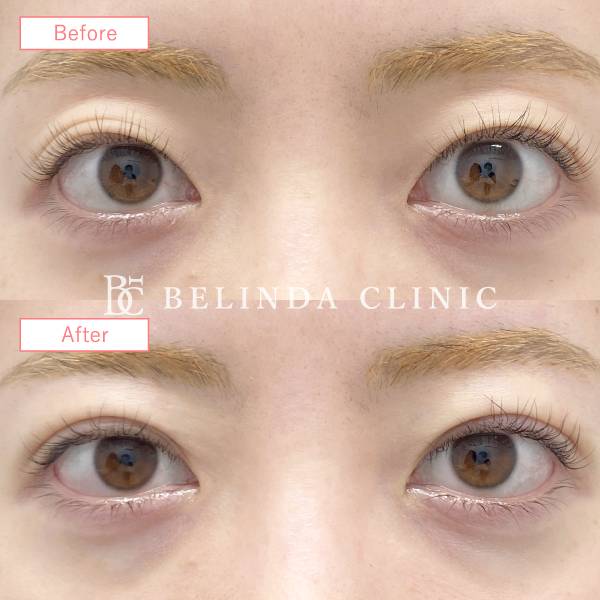 二重整形埋没法症例No7558