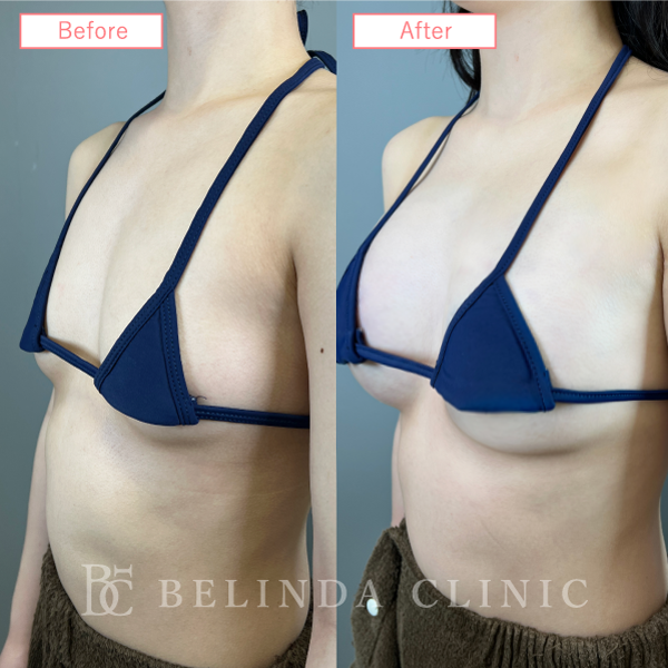 脂肪豊胸症例No7654