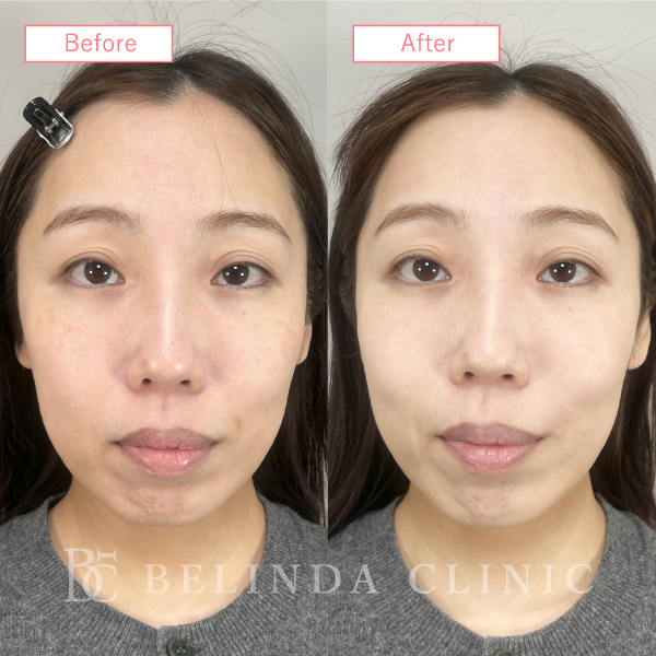 ルメッカ症例No1112