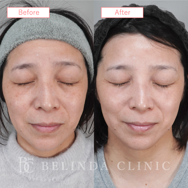 ルメッカビフォーアフターcase05