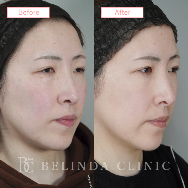 ルメッカビフォーアフターcase08