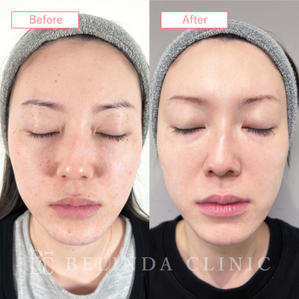 ルメッカ症例No525