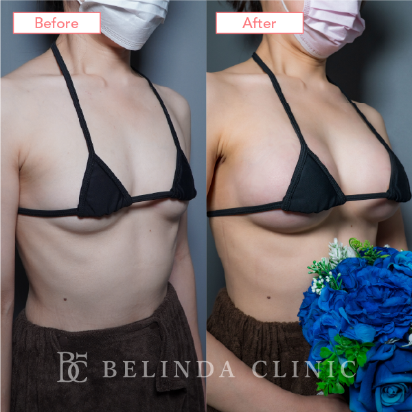 シリコンバッグ豊胸ビフォーアフターcase18