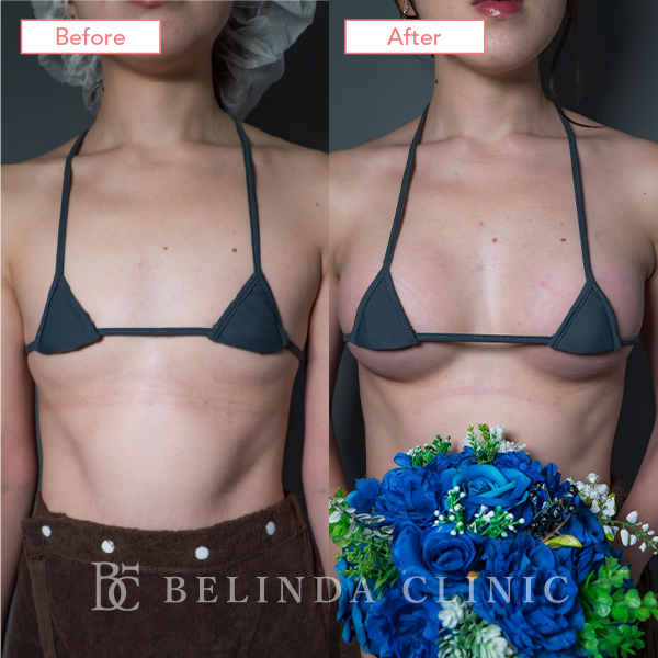 ハイブリット豊胸ビフォーアフターcase08