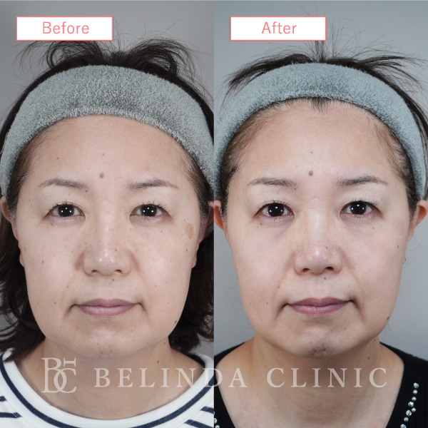 ルメッカビフォーアフターcase04