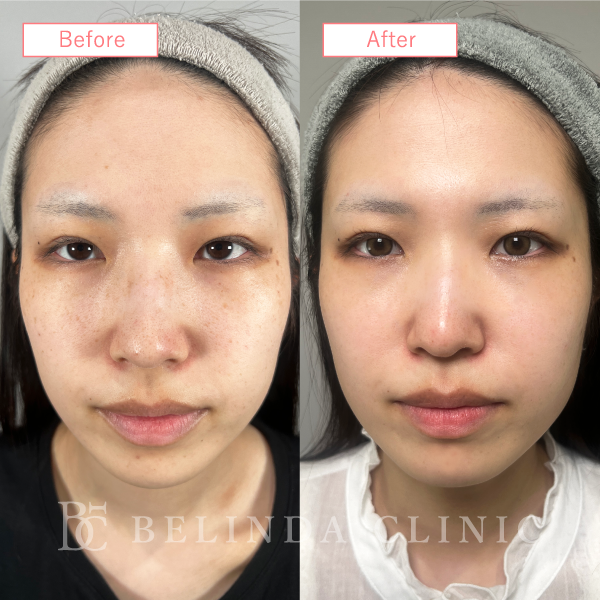 ルメッカビフォーアフターcase10