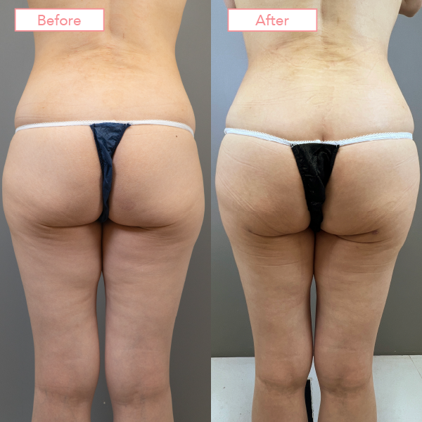 ブラジリアンバットリフト症例01