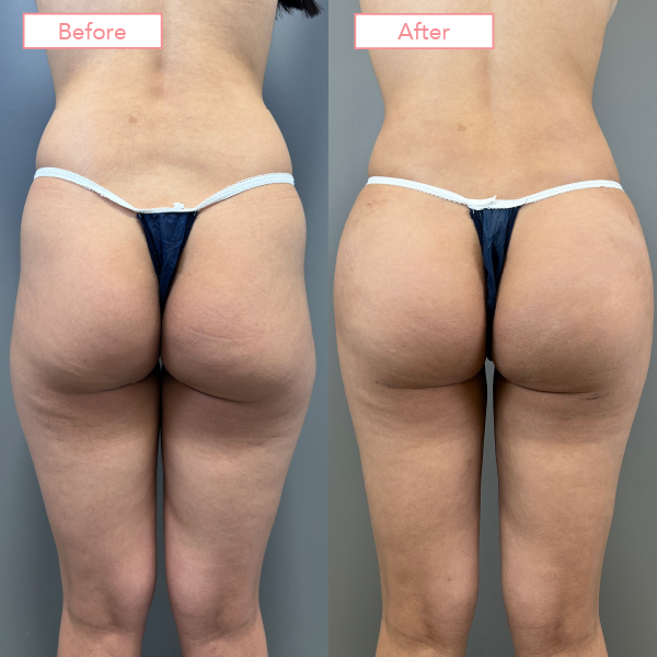 ブラジリアンバットリフト症例02
