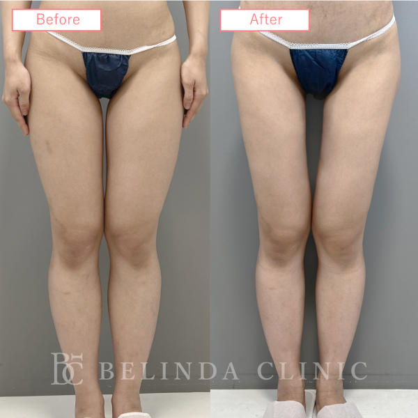 太もも脂肪吸引ビフォーアフターcase08