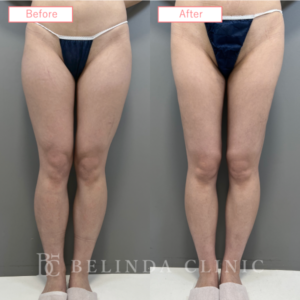 太もも脂肪吸引ビフォーアフターcase04