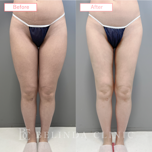 太もも脂肪吸引ビフォーアフターcase05