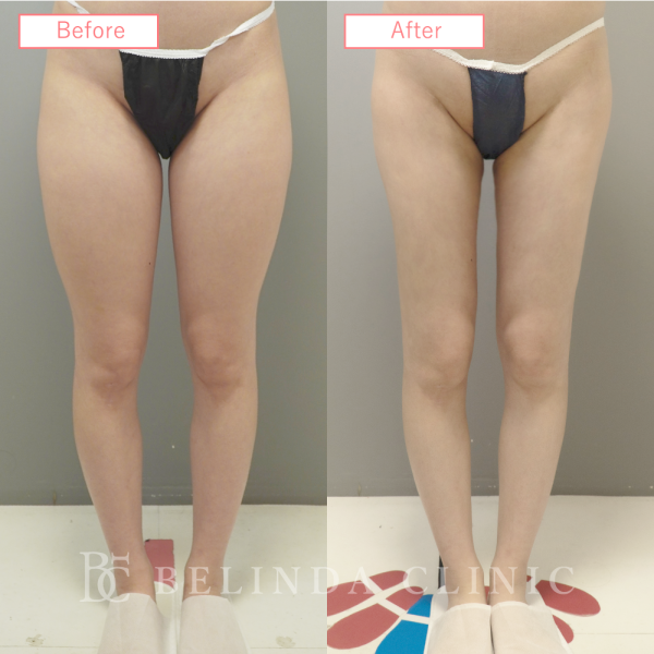 太もも脂肪吸引