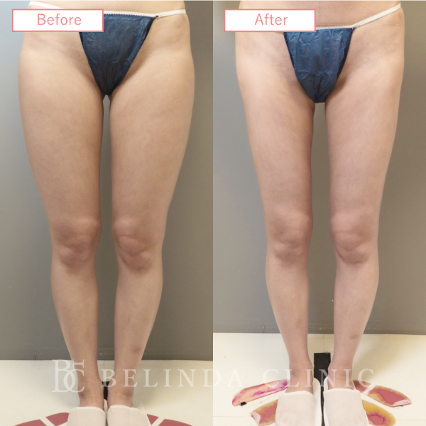 太もも脂肪吸引ビフォーアフターcase03