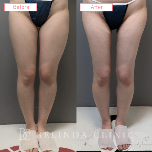 太もも脂肪吸引ビフォーアフターcase09