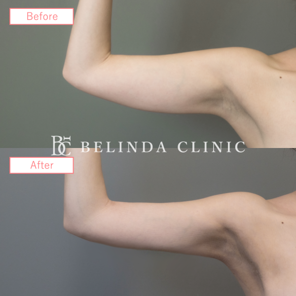 二の腕脂肪吸引ビフォーアフターcase02