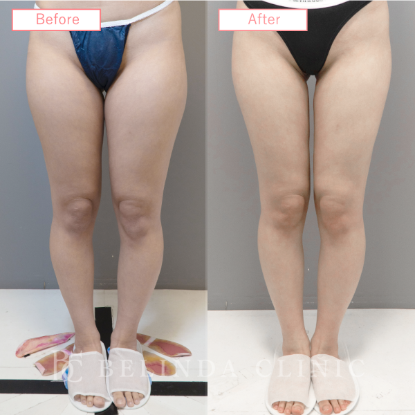 太もも脂肪吸引ビフォーアフターcase10