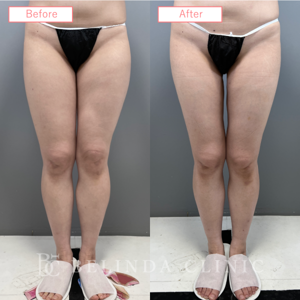 太もも脂肪吸引ビフォーアフターcase01