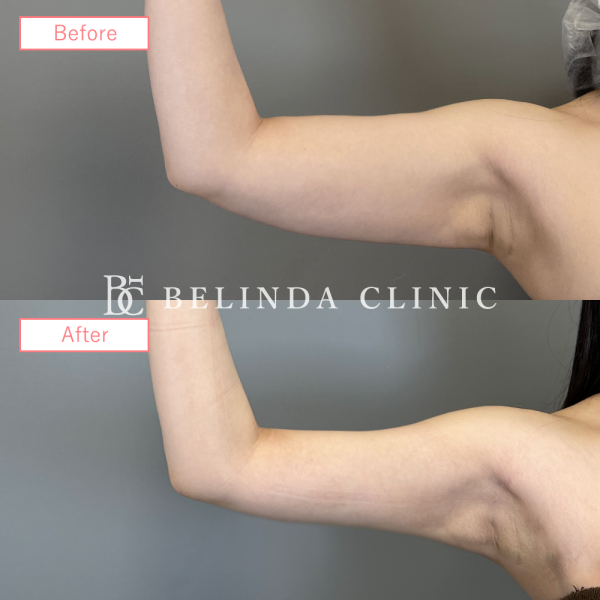 二の腕脂肪吸引症例