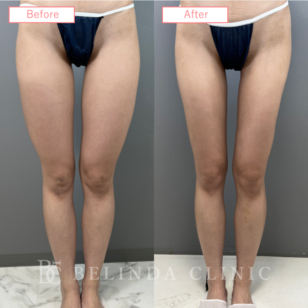 太もも脂肪吸引ビフォーアフターcase06